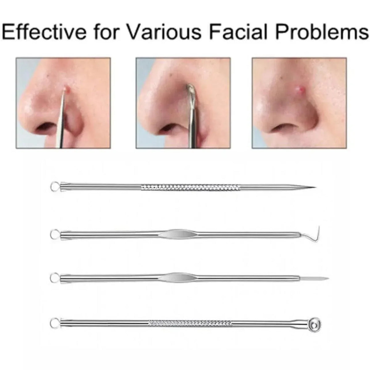 Stainless Steel Blackhead Remover Tools Set with Pimple Extractors 4 Pieces - Black